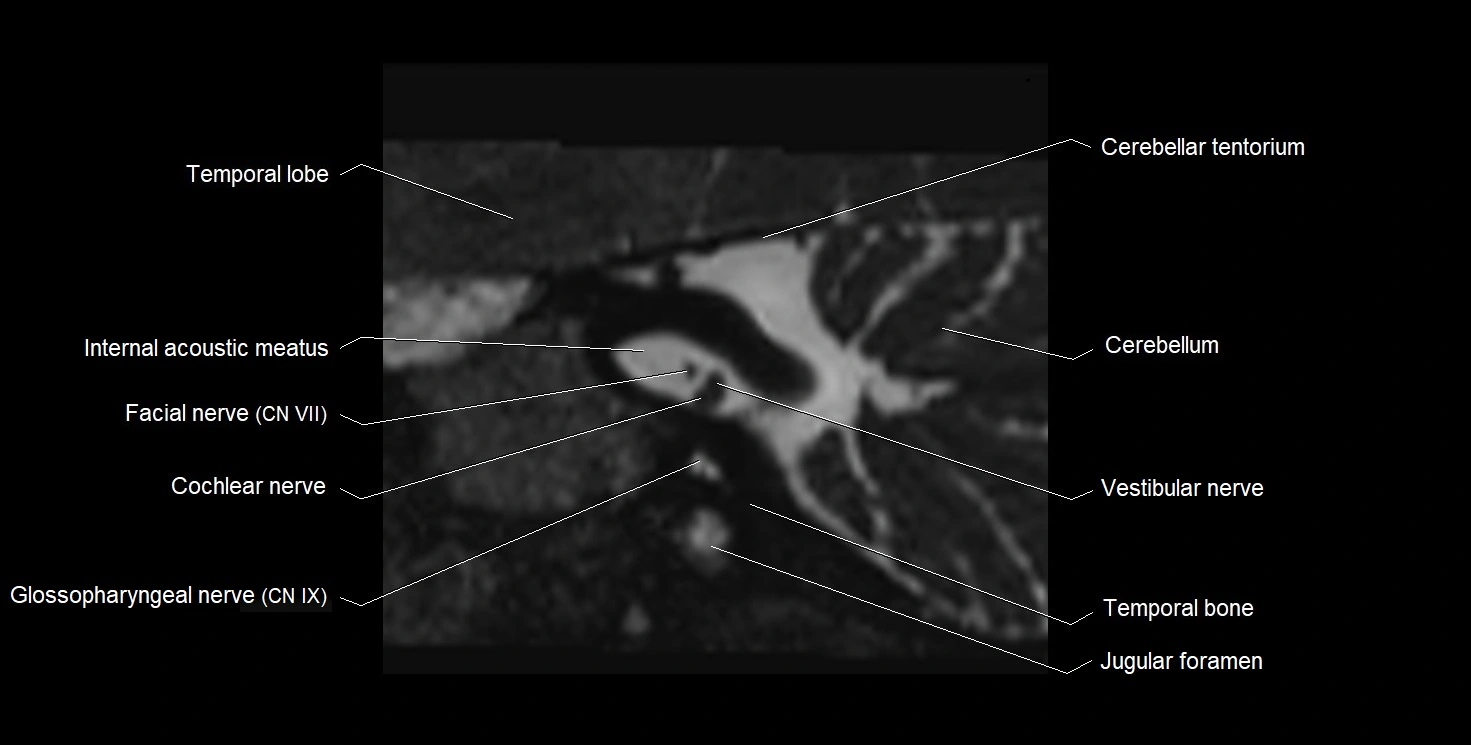 Internal auditory meatus (IAM) 3T sagittal cross sectional anatomy image 25.webp